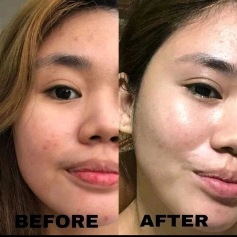 Sugar Dolls Rejuvenating Set (New Packaging) Micropeeling Set and Anti Acne Set Glass Skin