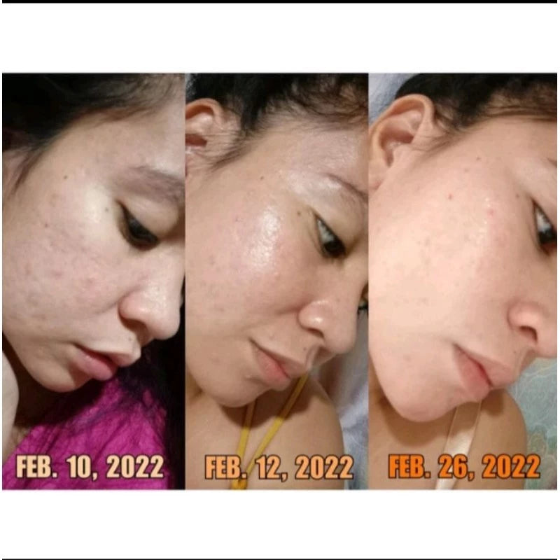 Sugar Dolls Rejuvenating Set (New Packaging) Micropeeling Set and Anti Acne Set Glass Skin